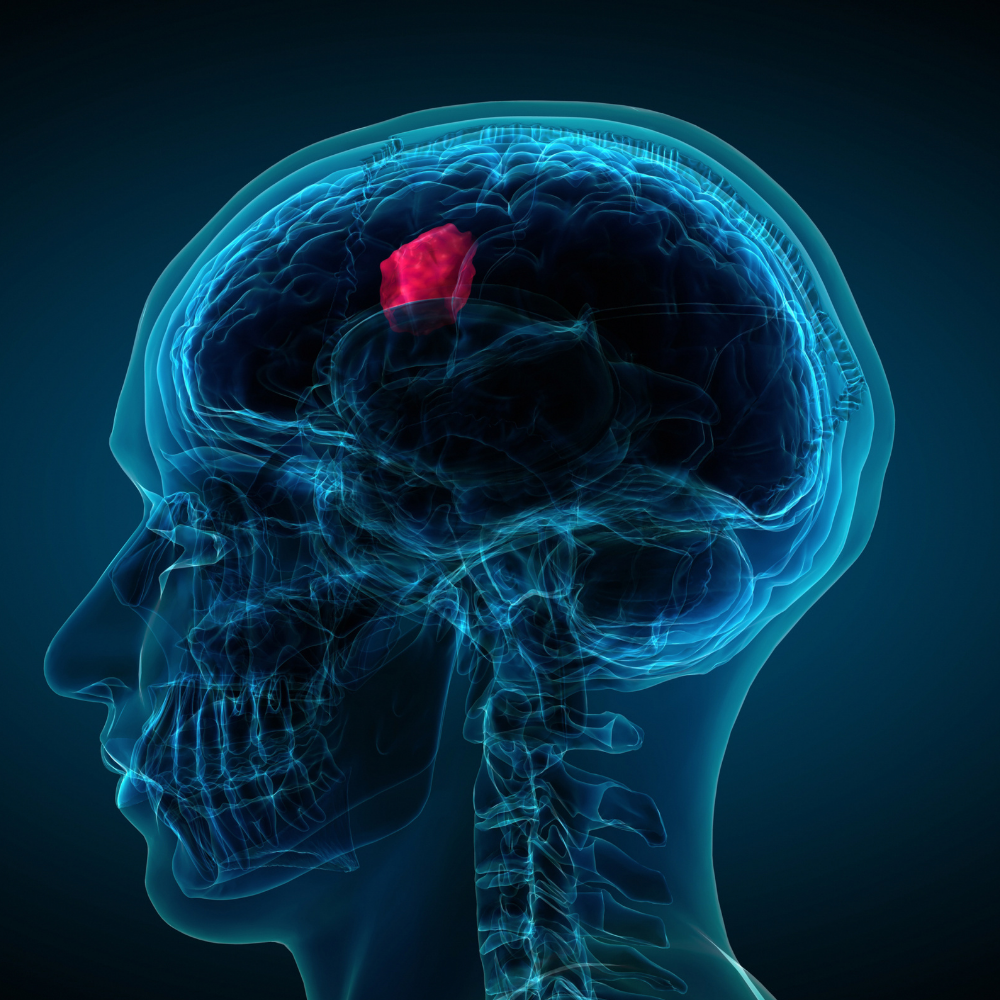 Brain tumor