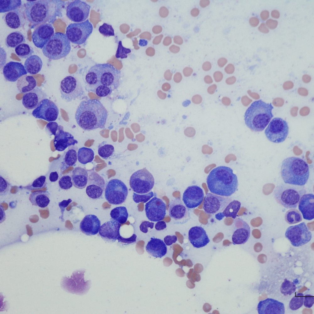 Multiple Myeloma